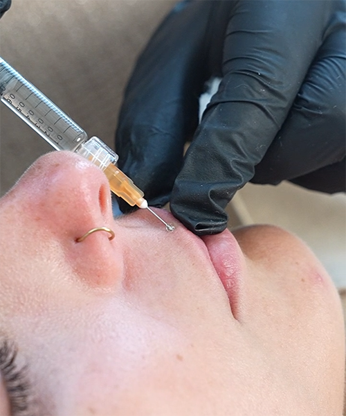 Aumento de labios